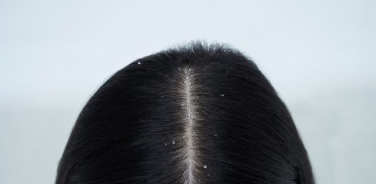 Top Best Home Remedies for Hair Dandruff Treatment